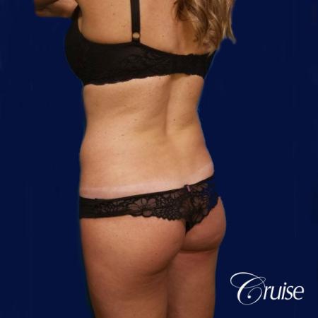 Brazilian Butt Lift Dr. Cruise - Before Image 3