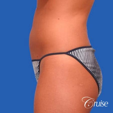 best liposuction abdomen and love handles - After Image 2
