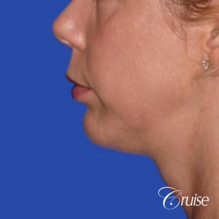 best medium anatomic chin implant on female - After Image 2