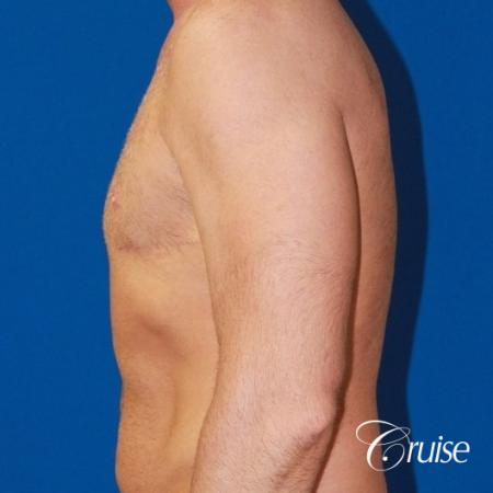 Free Nipple Graft male gynecomastia - After Image 2