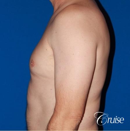 moderate gyne on mature adult 49 - Before and After Image 2
