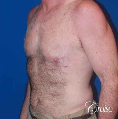 extended pa incision on gynecomastia patient - After Image 2