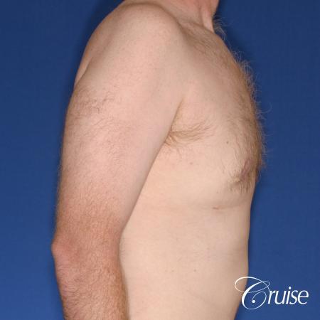 best donut lift with gynecomastia surgery - After Image 3