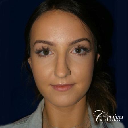 Rhinoplasty Dr. Cruise newport beach - Before Image 1