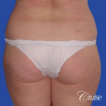 best pictures of liposuction abdomen with skin laxity - Before Image 1
