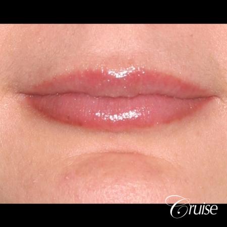 best before and after of lip filler - After Image 1