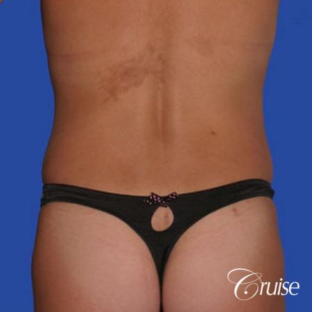 mommy makeover with best breast lift anchor with saline implants - After Image 5