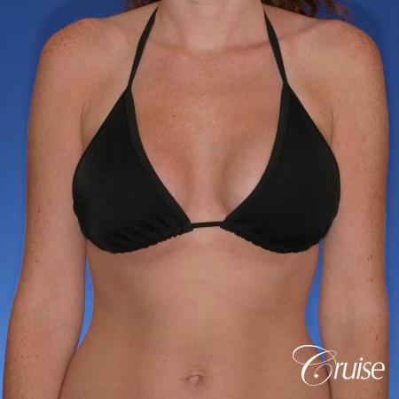 Breast Augmentation - After Image 4