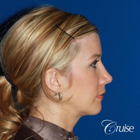 female patient with best chin implant scar - After Image 4