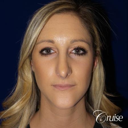 Best Rhinoplasty results Newport Beach CA - Before Image 1
