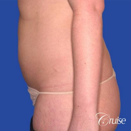 best skinny abs from liposuction abdomen and flanks - Before Image 3