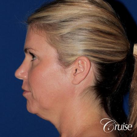 best small anatomic implant photos - Before Image 2