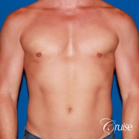 body builder with Gynecomastia puffy nipple - After Image 1