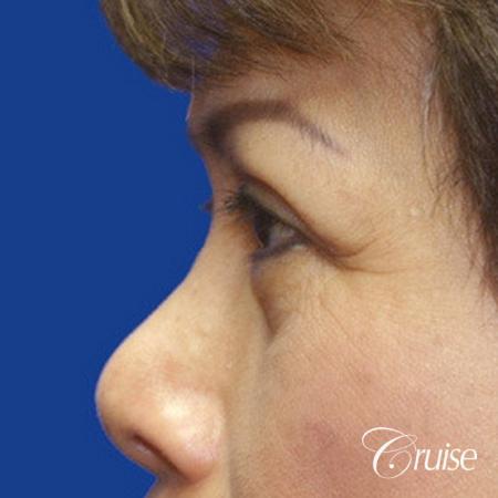 best Asian Upper eye lid plastic surgeon Newport Beach - After Image 2