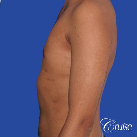 best before and after results for gynecomastia surgery - After 2
