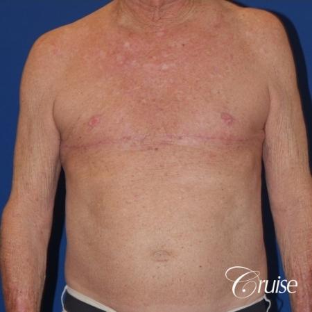 free nipple graft gynecomastia on old man - After Image 1