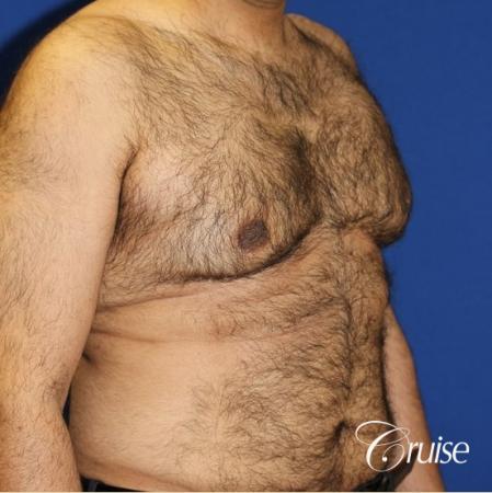 40 year old with severe gynecomastia results - Before Image 2