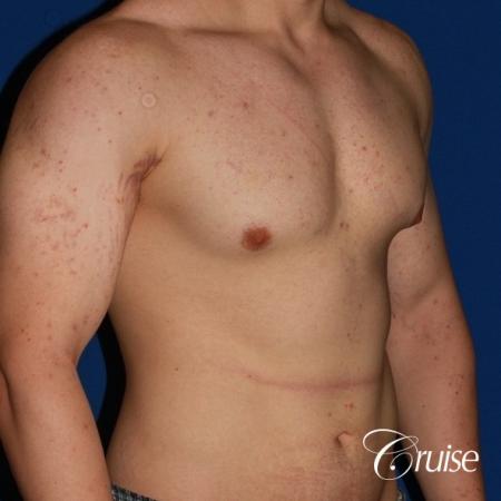 mild-gynecomastia-revision - Before Image 3