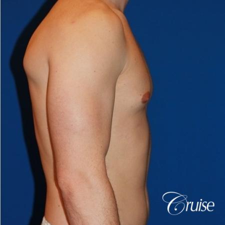 32 yo with Gynecomatia and Puffy Nipple - Before Image 4