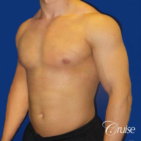 Type 1 Body Builder Puffy Nipple Correction - After 2