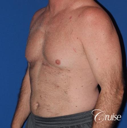 extended pa incision on gynecomastia patient - Before Image 2
