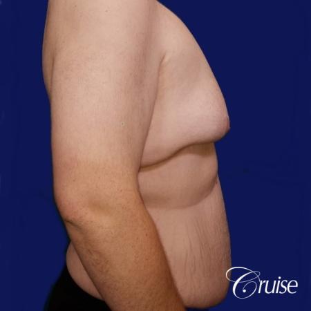 severe gynecomastia - Before Image 2
