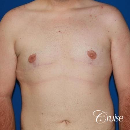 moderate gynecomastia with pointy man boobs - After Image 1