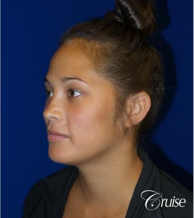 Otoplasty - Before Image 2