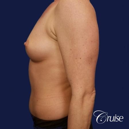 Breast Augmentation - Before 2