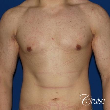 mild-gynecomastia-revision - After Image 1