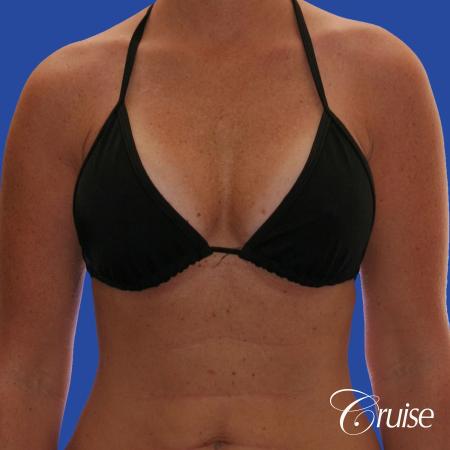 Breast Augmentation - After Image 3