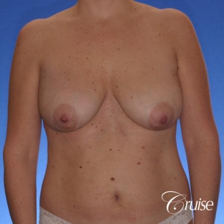 breast lift anchor on mature woman 21 - Before Image 1