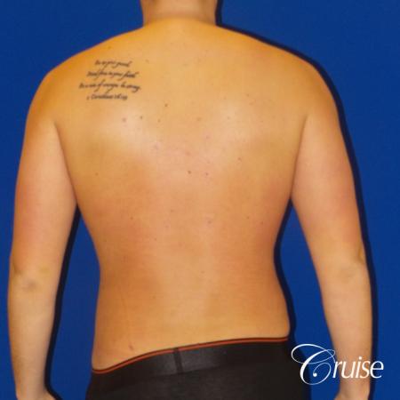 Best before and after lipo photos of guys - After Image 4