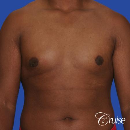 male breast moderate gynecomastia on young teen - After Image 1