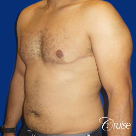 Best gynecomastia specialist in united states - After Image 2