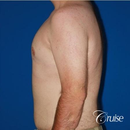 moderate gynecomastia with pointy man boobs - After Image 2