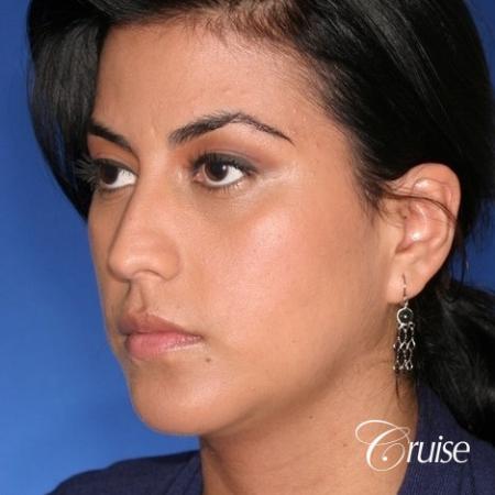 best XL chin implant on female patient - After Image 3