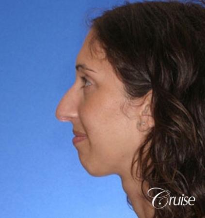 29 yr old with large female chin augmentation - Before Image 2