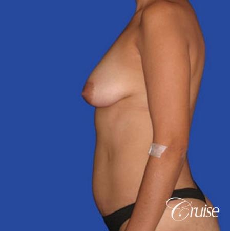 mommy makeover with silicone lollipop lift with best scars - Before Image 2