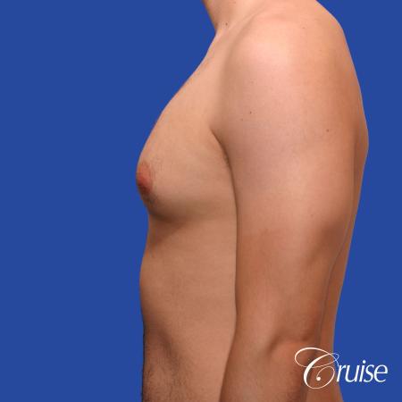 20 year old with moderate gynecomastia - Before Image 2