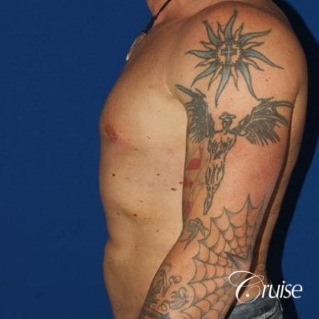 moderate gynecomastia with puffy nipple on athletic adult - After Image 3
