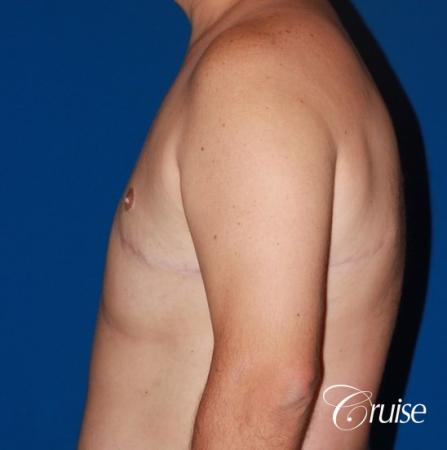 male breast severe gynecomastia free nipple graft anchor - After Image 2