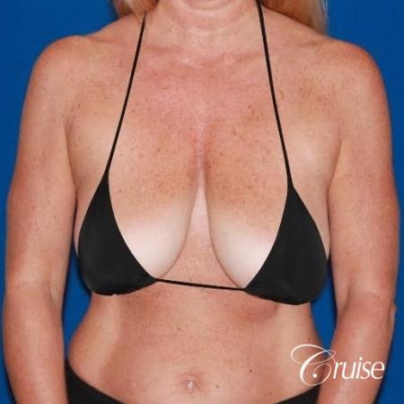 best breast lift with implants - Before and After Image 5