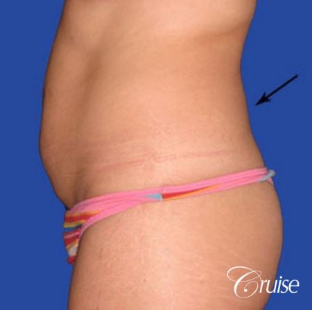 dramatic liposuction plastic surgeon does the best abdomen and flanks - Before and After Image 2