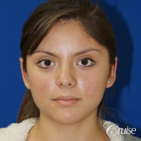 best before and after pictures of otoplasty - After Image 1