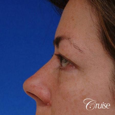 blepharoplasty specialist - Before Image 2