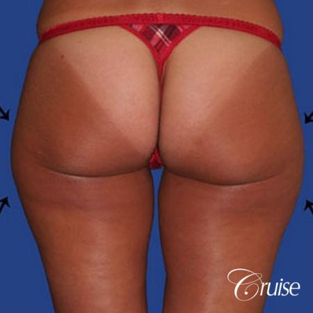 best thigh thinning liposuction on thighs - Before Image 1