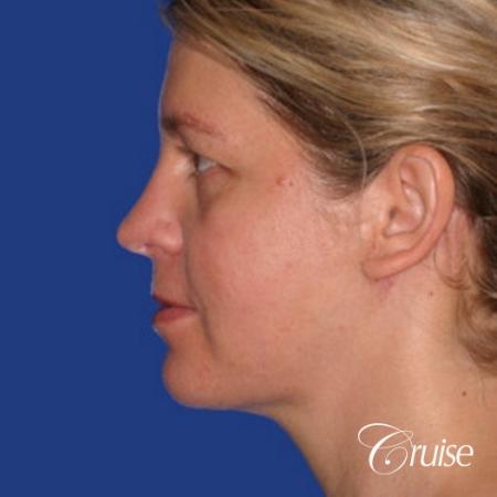 female who got large chin implant in Newport Beach - After Image 2
