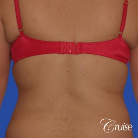 best liposuction pictures of flanks and lipo back - After Image 1