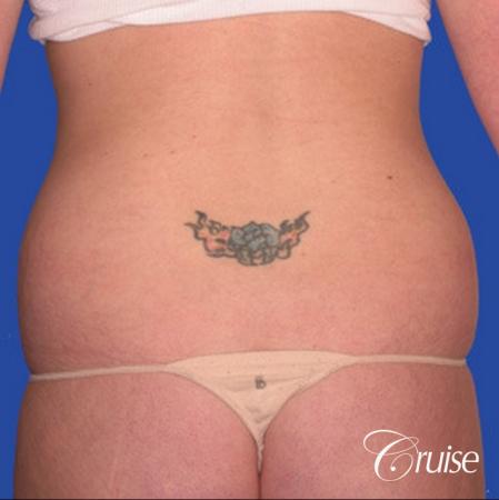 best skinny abs from liposuction abdomen and flanks - Before Image 2